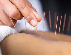 In House Acupuncture